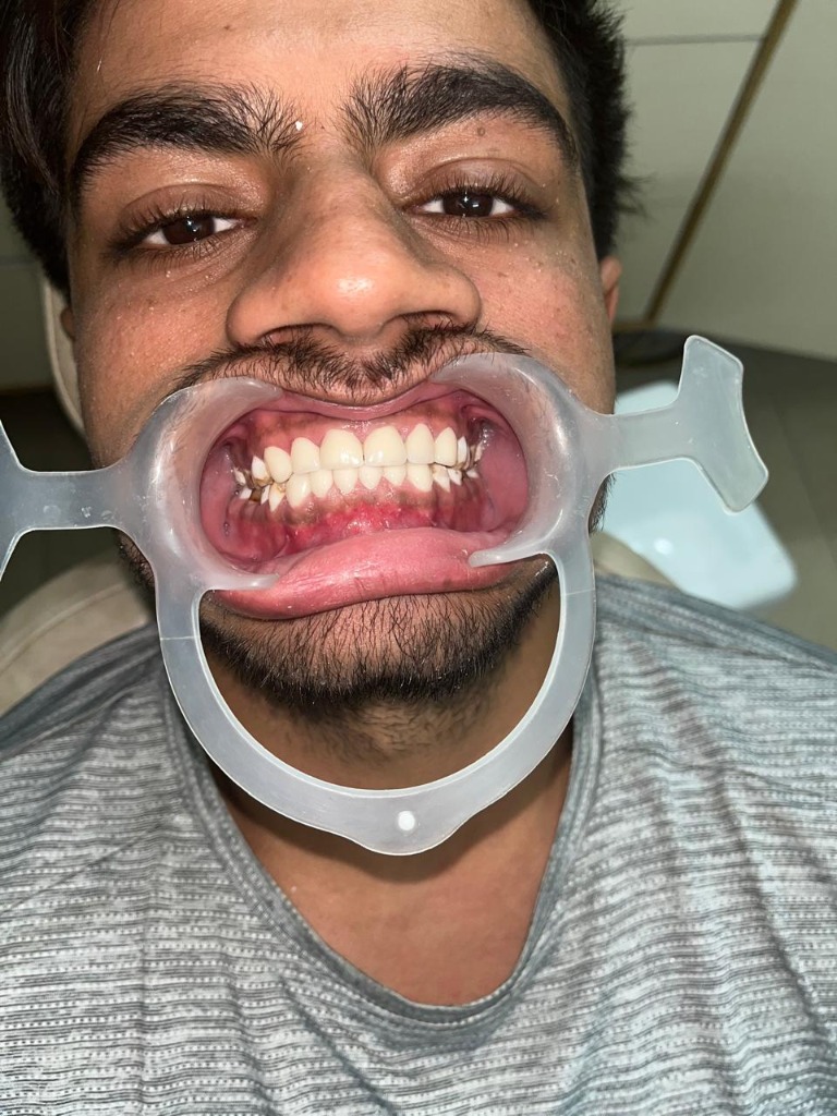 After professional dental scaling and polishing at Oriiface Dental Rohtak