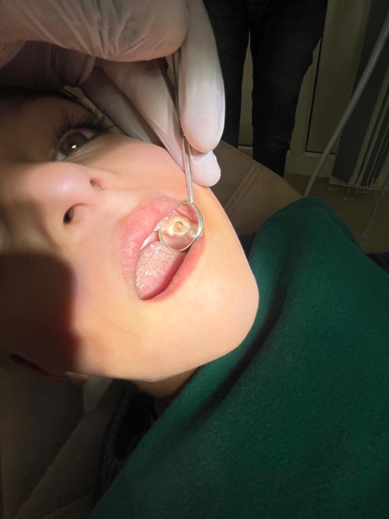 Root canal treatment procedure at Oriiface Dental Clinic, Delhi Bypass Chowk Rohtak